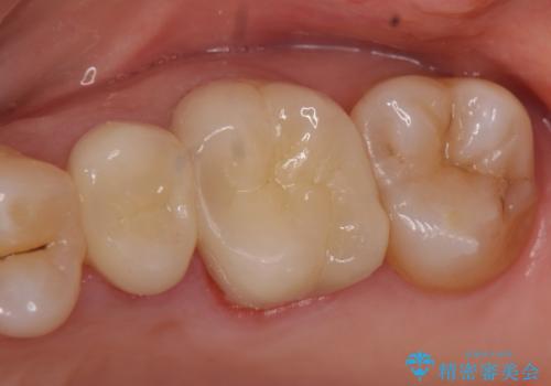 オールセラミッククラウン 痛みが治まらない歯の治療の症例 治療後