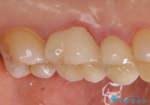 オールセラミッククラウン 痛みが治まらない歯の治療の治療後