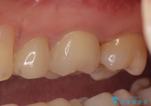 オールセラミッククラウン 痛みが治まらない歯の治療の治療後