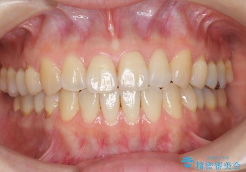 矯正治療後、オフィスホワイトニングで歯を白くしてさらに口元を美しく。の症例 治療前