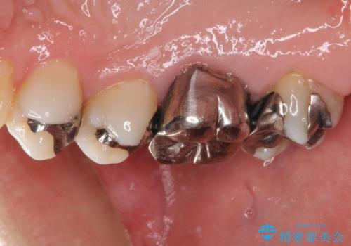 痛む奥歯 セラミッククラウンによるむし歯治療の治療前