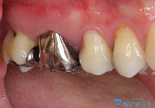 痛む奥歯 セラミッククラウンによるむし歯治療の治療前