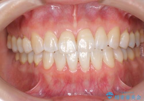 矯正治療後、オフィスホワイトニングで歯を白くしてさらに口元を美しく。