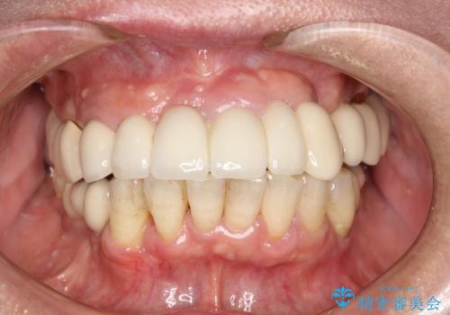 定期的なPMTCでオーラルケア