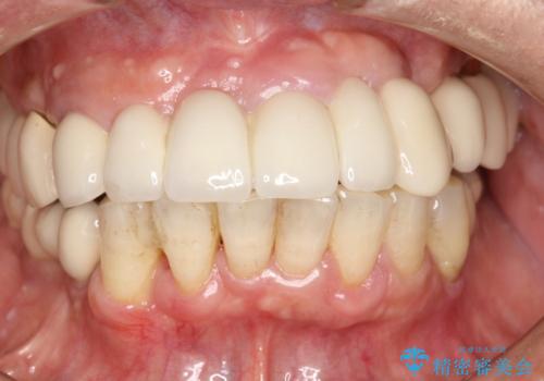 定期的なPMTCでオーラルケアの治療前