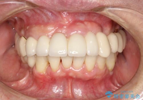 定期的なPMTCでオーラルケアの治療後