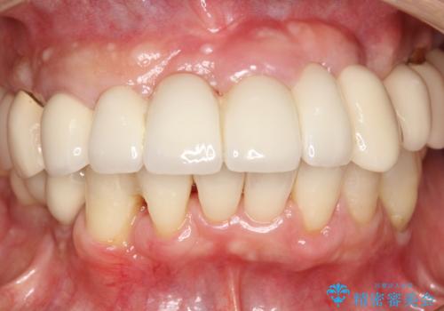 定期的なPMTCでオーラルケアの治療後