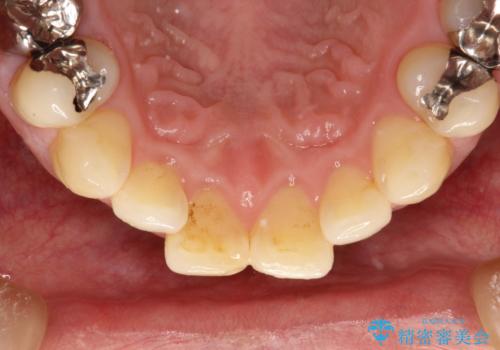 磨けているようで磨けていない汚れをPMTCで徹底的に除去の治療前