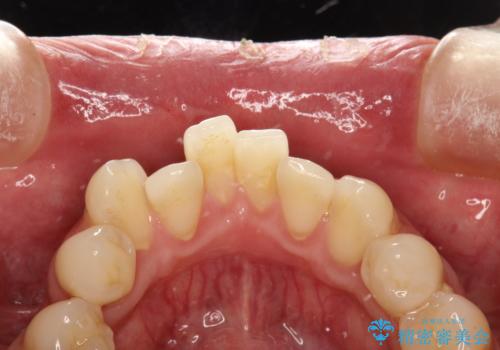 磨けているようで磨けていない汚れをPMTCで徹底的に除去の治療前