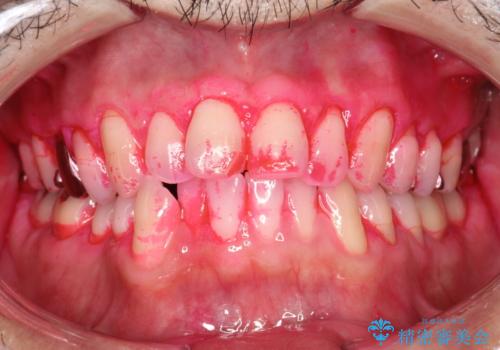 磨けているようで磨けていない汚れをPMTCで徹底的に除去