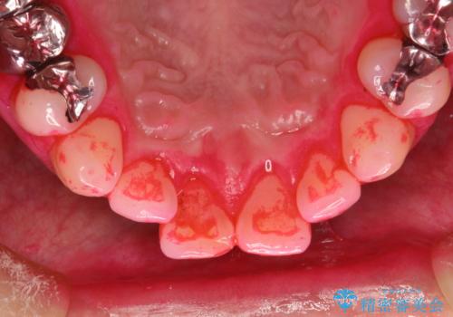 磨けているようで磨けていない汚れをPMTCで徹底的に除去の治療中