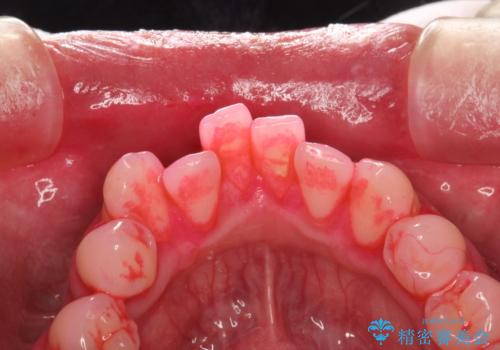 磨けているようで磨けていない汚れをPMTCで徹底的に除去の治療中