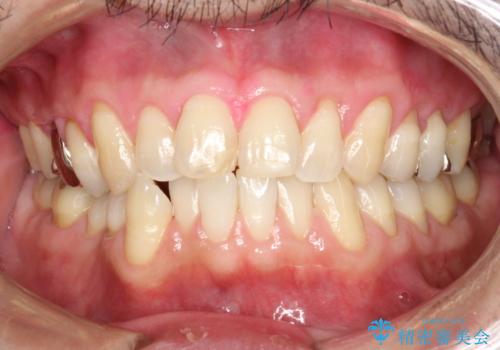 磨けているようで磨けていない汚れをPMTCで徹底的に除去の治療後