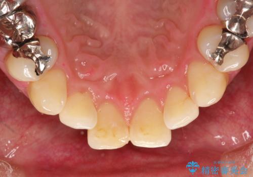 磨けているようで磨けていない汚れをPMTCで徹底的に除去の治療後