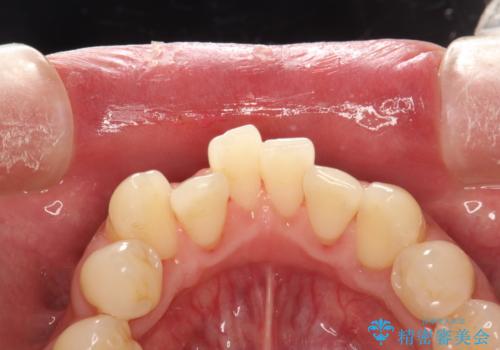 磨けているようで磨けていない汚れをPMTCで徹底的に除去の治療後