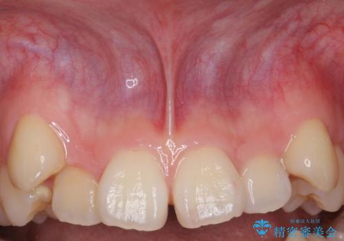 上唇小帯切除 矯正前の予防的外科処置の治療前