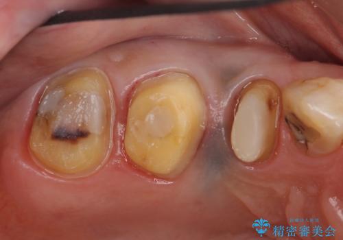 オールセラミッククラウン しみる歯の治療の治療中