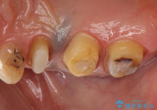 オールセラミッククラウン しみる歯の治療の治療中