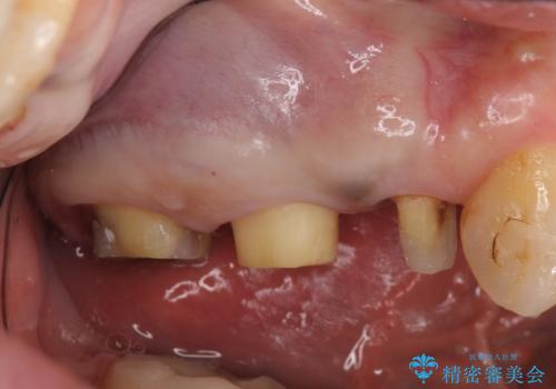 オールセラミッククラウン しみる歯の治療の治療中