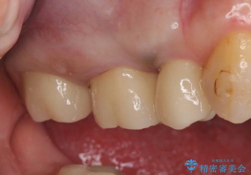 オールセラミッククラウン しみる歯の治療の治療後