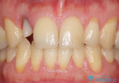 オールセラミッククラウン メタルフリーのクラウンへの治療中