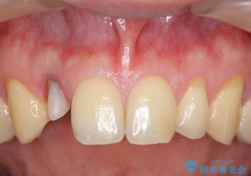 オールセラミッククラウン メタルフリーのクラウンへの治療中