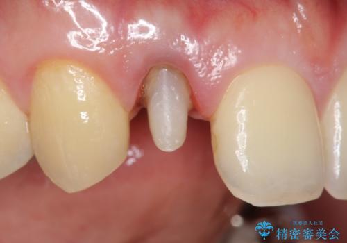 オールセラミッククラウン メタルフリーのクラウンへの治療中