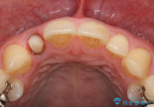 オールセラミッククラウン メタルフリーのクラウンへの治療中