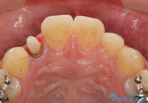 オールセラミッククラウン メタルフリーのクラウンへの治療中