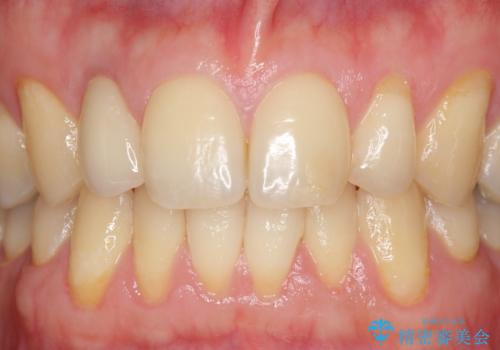オールセラミッククラウン メタルフリーのクラウンへの治療後