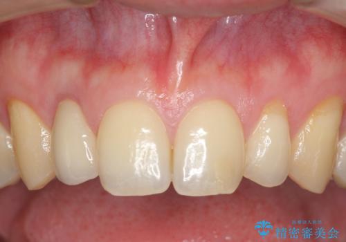 オールセラミッククラウン メタルフリーのクラウンへの症例 治療後