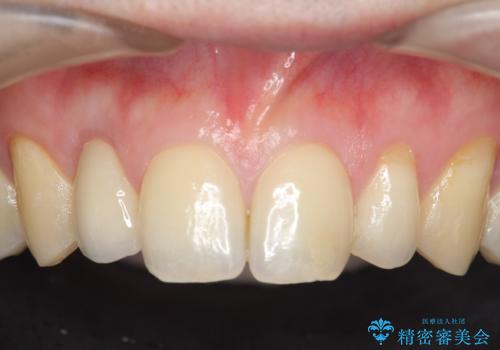 オールセラミッククラウン メタルフリーのクラウンへの治療後