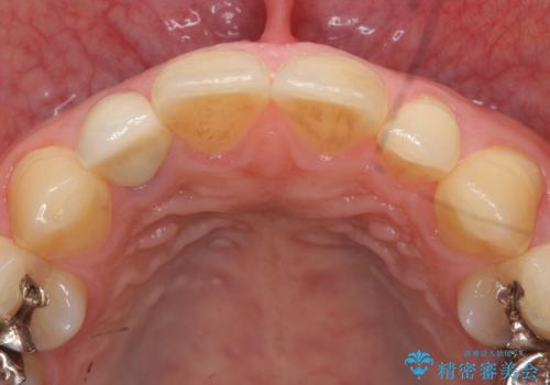 オールセラミッククラウン メタルフリーのクラウンへの治療後