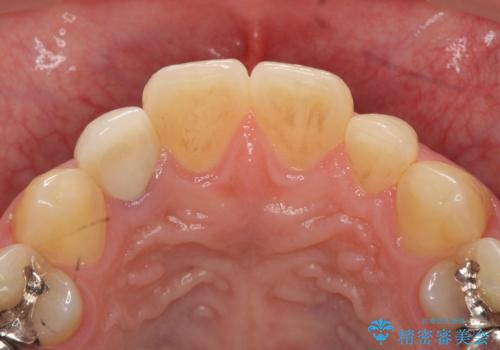 オールセラミッククラウン メタルフリーのクラウンへの治療後