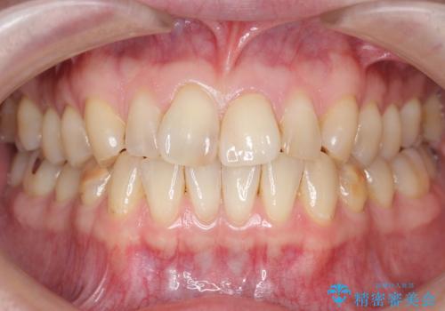 前歯のつめもの きれいにしたい 30代男性の治療後