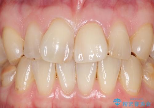 前歯のつめもの きれいにしたい 30代男性の治療後