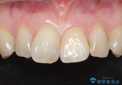 前歯のつめもの きれいにしたい 30代男性の治療後