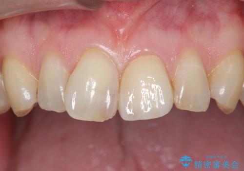 前歯のつめもの きれいにしたい 30代男性の治療後