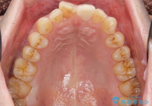 前歯のつめもの きれいにしたい 30代男性の治療後