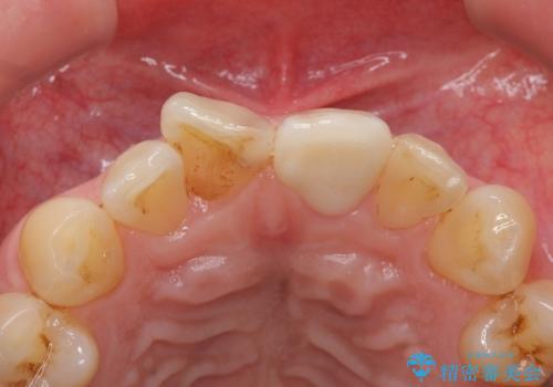 前歯のつめもの きれいにしたい 30代男性の治療後