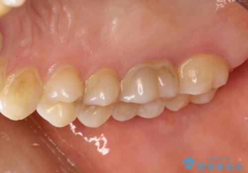 定期的にPMTCで口元ケアを