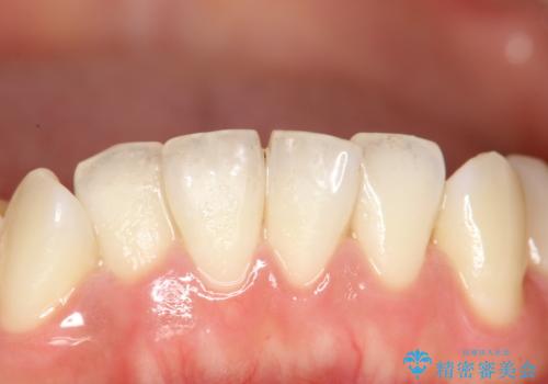 定期的にPMTCで口元ケアをの症例 治療前