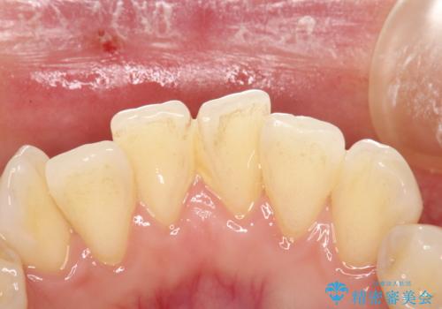 定期的にPMTCで口元ケアをの治療前