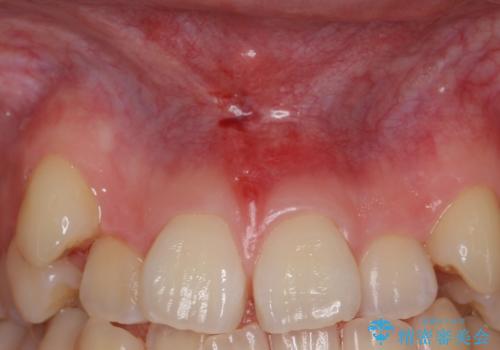 上唇小帯切除 矯正前の予防的外科処置の治療後