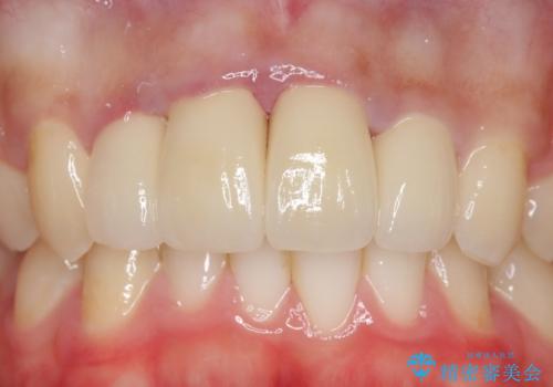 セラミック矯正 気になる前歯の歯並びの改善の治療後