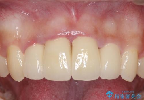 セラミック矯正　気になる前歯の歯並びの改善の症例 治療後