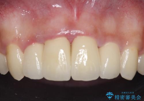 セラミック矯正 気になる前歯の歯並びの改善の治療後