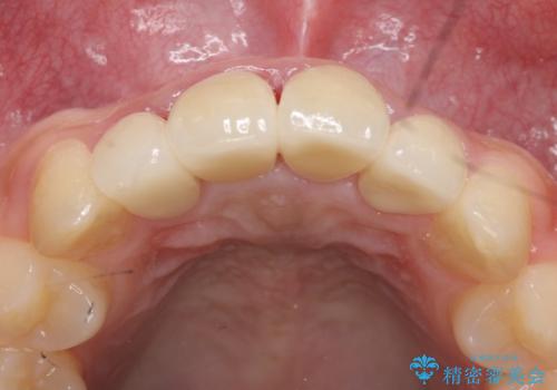 セラミック矯正 気になる前歯の歯並びの改善の治療後