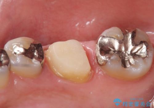 オールセラミッククラウン 他院にて根管治療を勧められた歯の治療の治療中