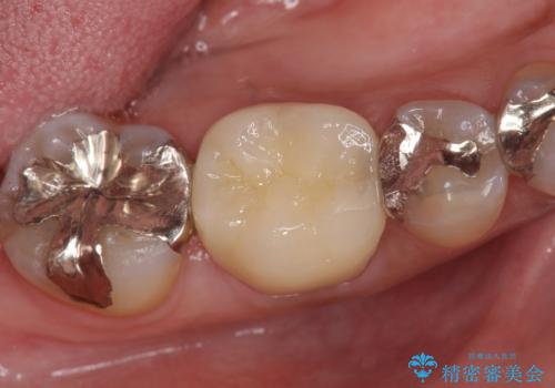 オールセラミッククラウン 他院にて根管治療を勧められた歯の治療の治療後